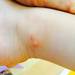 【夏に流行・手足口病】３歳の娘の症状と回復