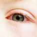 子どもがかかりやすい目の病気【結膜炎】って？