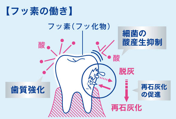 フッ素のむし歯予防に役立つ効果